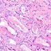 Amyloidosis renis (HE)1