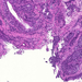 bronchus-metaplasia-dysplasia-carcinomakontroll