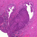 cervix in situ carcinoma mirigyhámba pseudoinvázzió