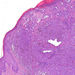 Melanoma malignum cutis epidermis eltunik