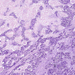 adenocarcinoma pulmonis1