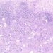 adenocarcinoma renis lymphocitás infiltráció