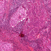 carcinoma cervicis laphámsziget