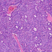 Carcinoma hepatocellulare pseudoglandularis