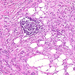 carcinoma lobulare invasivum mammae ly