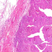 carcinoma transitiocellulare izomréteg 2