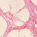 cirrhosis hepatis (picro)2