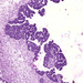 cystadenocarcinoma ovarii papillaris képlet
