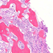 myelofibrosis (HE)0