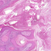 carcinoma planocellulare cutis 3